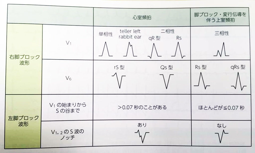 wide QRS tachycardiaの鑑別 | ECG-Cafe