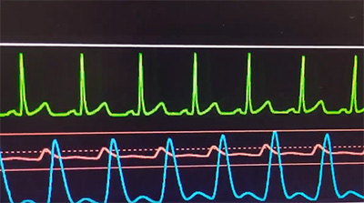洞性頻脈 Ecg Cafe